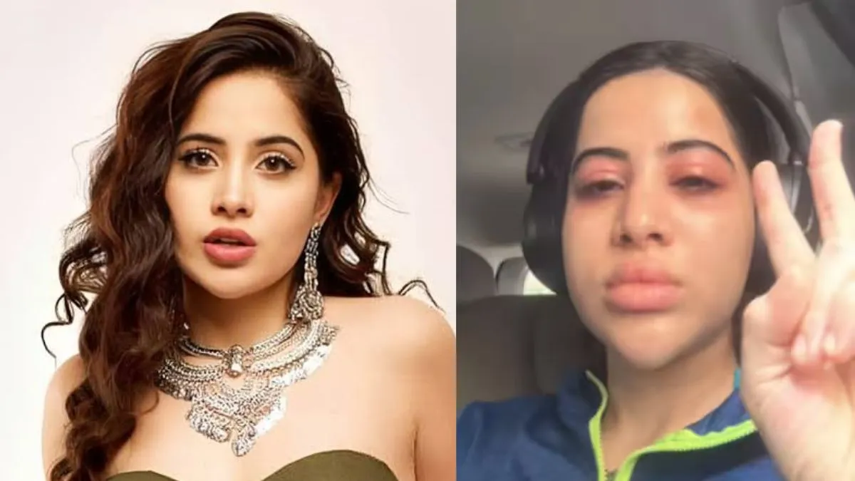 Urfi Javed Allergy: उर्फी जावेद की फिर बिगड़ी हालत, चेहरे पर आई भारी सूजन, फोटो शेयर कर दिखाया एलर्जी का दर्द