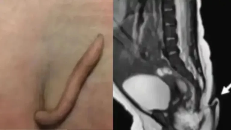 Baby Born With Tail: मैक्सिको में पूंछ के साथ जन्मी बच्ची, मेडिकल हिस्ट्री का दुर्लभतम मामला देख हैरान रह गए डॉक्टर